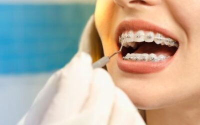 Quais os benefícios do aparelho dentário?