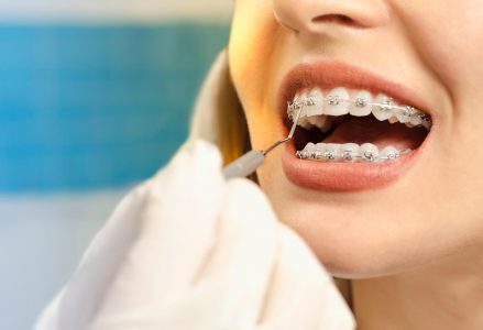 Quais os benefícios do aparelho dentário?